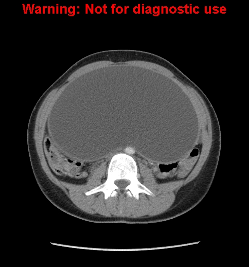 Borderline mucinous cystadenoma of ovary (Radiopaedia 25586-25767 A 30).jpg