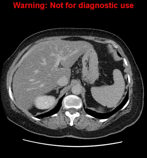 File:Bosniak renal cyst - type II (Radiopaedia 23404-23468 F 14).jpg