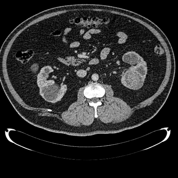 Bosniak renal cyst - type IV (Radiopaedia 24244-24518 C 165).jpg