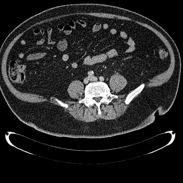 File:Bosniak renal cyst - type IV (Radiopaedia 24244-24518 C 254).jpg