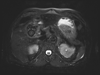 File:Bouveret syndrome (Radiopaedia 61017-68856 Axial MRCP 21).jpg