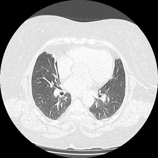 Bovine aortic arch - right internal mammary vein drains into the superior vena cava (Radiopaedia 63296-71875 Axial lung window 91).jpg