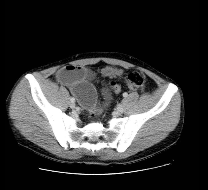 Bowel obstruction from colon carcinoma (Radiopaedia 22995-23028 A 68).jpg