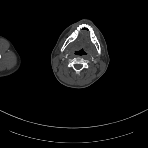 Brachiocephalic trunk pseudoaneurysm (Radiopaedia 70978-81191 Axial bone window 10).jpg