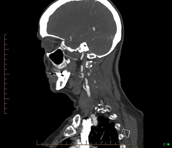 Brachiocephalic trunk stenosis (Radiopaedia 87242-103519 C 46).jpg