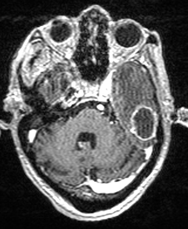 Brain abscess with dual rim sign (Radiopaedia 87566-103938 Axial T1 C+ 49).jpg