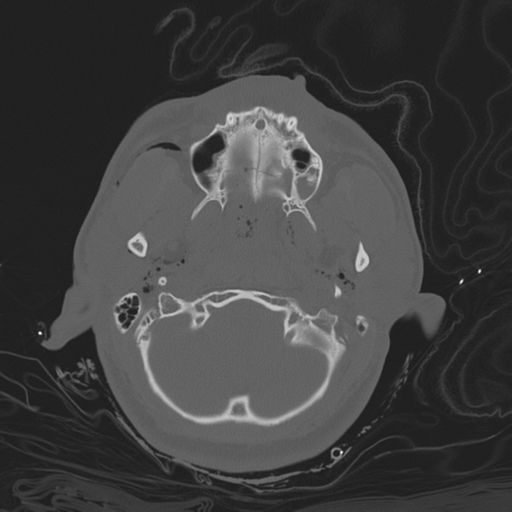 File:Brain contusions, internal carotid artery dissection and base of skull fracture (Radiopaedia 34089-35339 Axial bone window 43).png