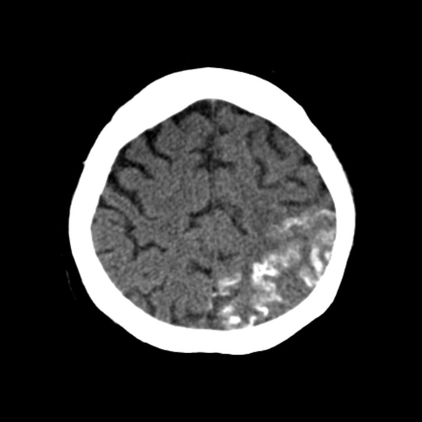 Brain cortical laminar necrosis (Radiopaedia 25822-25971 Axial non-contrast 36).jpg