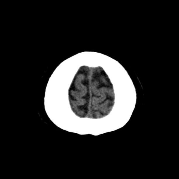 Brain cortical laminar necrosis (Radiopaedia 25822-25971 Axial non-contrast 46).jpg