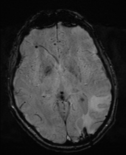 Brain metastases - lung cancer primary (Radiopaedia 75060-86115 Axial SWI 31).jpg