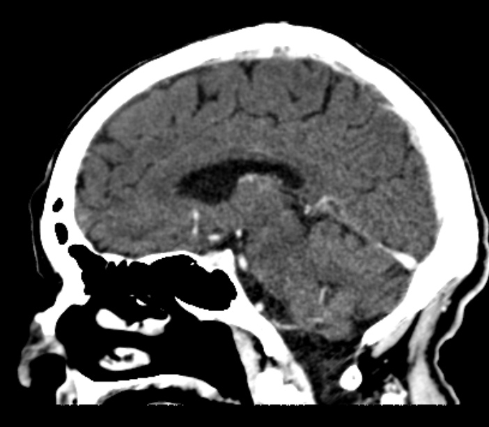 Brain metastases from lung cancer (Radiopaedia 27849-28092 Sagittal C+ delayed 34).jpg