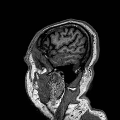 Brain metastases from lung cancer (Radiopaedia 83839-99028 Sagittal T1 117).jpg