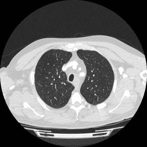 File:Brain metastases from lung cancer (Radiopaedia 83839-99030 Axial lung window 6).jpg