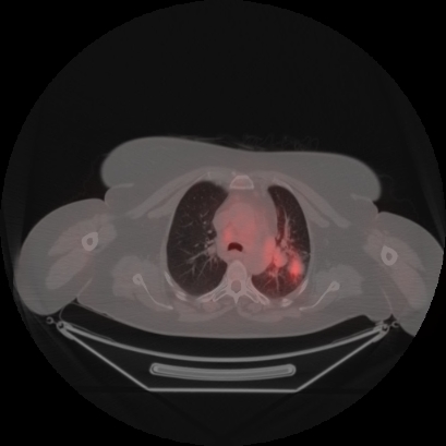 Brain metastasis (Radiopaedia 89847-106962 Axial lung window 17).jpg