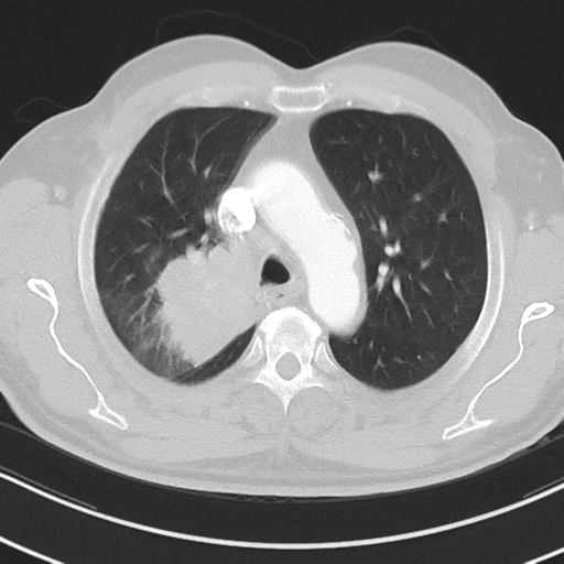 Brain metastasis (large cystic mass) (Radiopaedia 47497-52104 Axial lung window 14).png