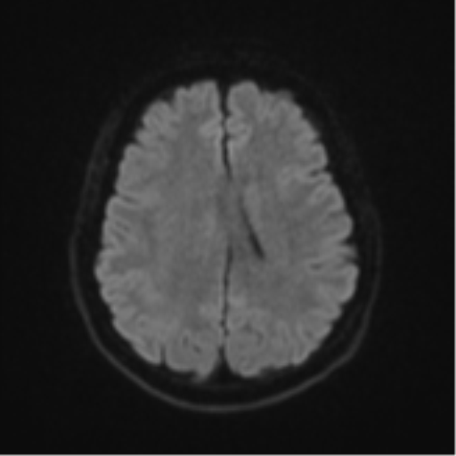 Brain metastasis (sarcoma) (Radiopaedia 47576-52209 Axial DWI 45).png