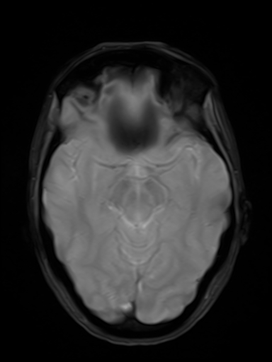 File:Brain metastasis as initial presentation of non-small cell lung cancer (Radiopaedia 65122-74126 Axial T2* 9).jpg