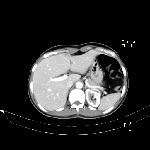 Brain metastasis as initial presentation of non-small cell lung cancer (Radiopaedia 65122-74127 A 48).jpg