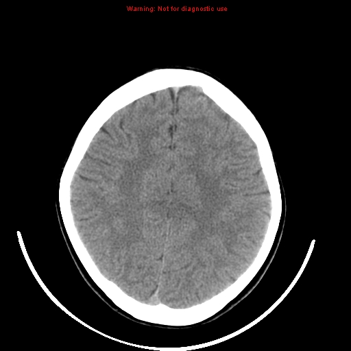File:Brainstem glioma (Radiopaedia 9444-10123 non-contrast 18).jpg