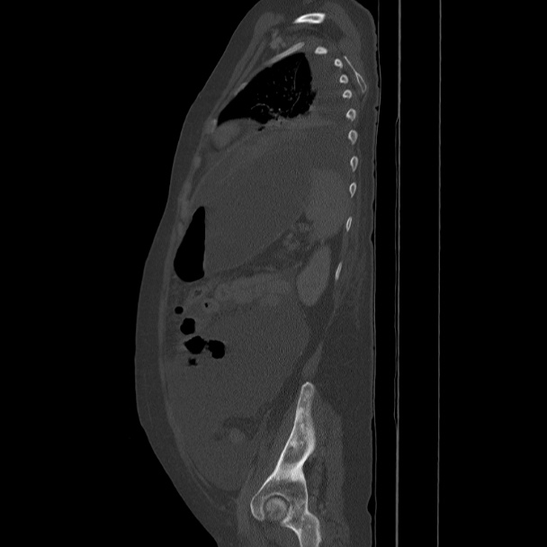 Breast cancer metastases - hepatic and skeletal (Radiopaedia 34201-35461 Sagittal bone window 70).jpg