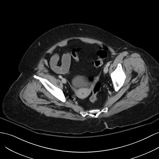 File:Breast carcinoma with pathological hip fracture (Radiopaedia 60314-67974 B 62).jpg