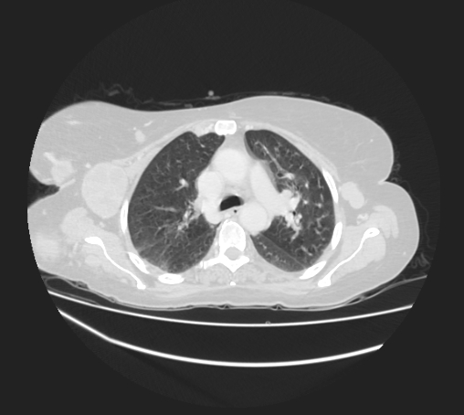 Breast metastases from facial malignant melanoma (Radiopaedia 60316-67975 Axial lung window 34).jpg