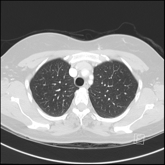 File:Breast metastases from renal cell cancer (Radiopaedia 79220-92225 Axial lung window 19).jpg