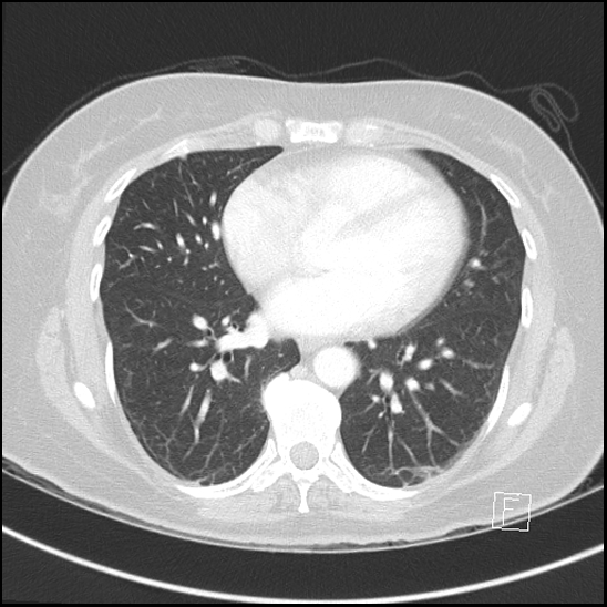 Breast metastases from renal cell cancer (Radiopaedia 79220-92225 Axial lung window 53).jpg
