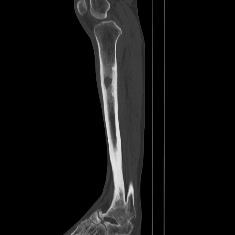 Brodie abscess - tibia (Radiopaedia 66028-75204 Sagittal bone window 35).jpg
