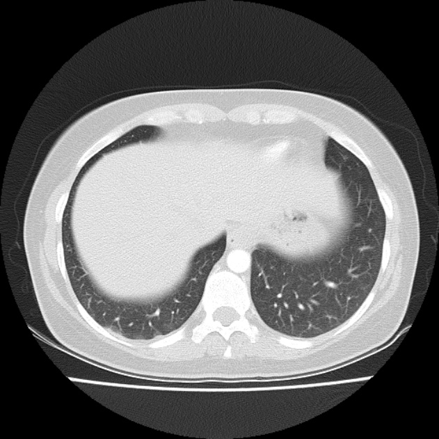 Bronchial atresia (Radiopaedia 22965-22992 Axial lung window 12).jpg