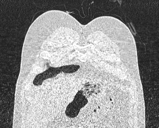Bronchial atresia (Radiopaedia 58271-65417 Coronal lung window 3).jpg