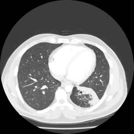 Bronchial carcinoid (Radiopaedia 80013-93291 Axial lung window 84).jpg