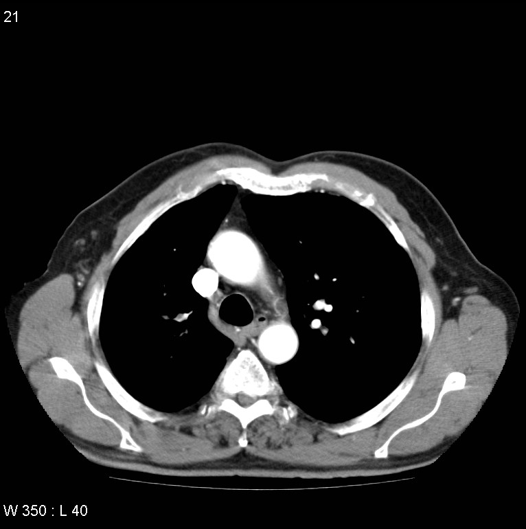 Bronchial carcinoid tumor with right lower lobe collapse (Radiopaedia 29060-29422 A 20).jpg