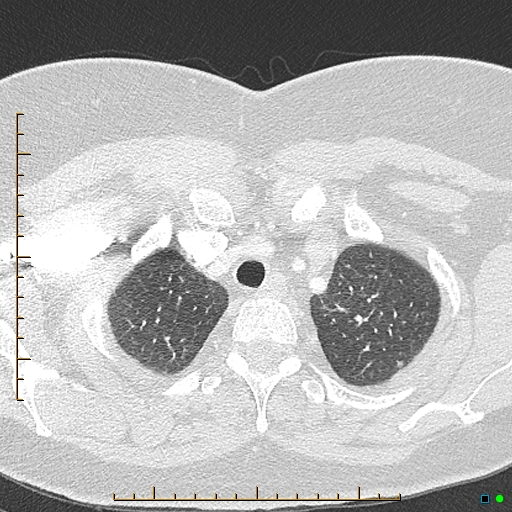 Bronchial diverticula (Radiopaedia 79512-92676 Axial lung window 17).jpg