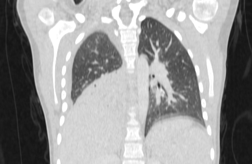 Bronchial mucoepidermoid carcinoma (Radiopaedia 57023-63895 Coronal lung window 48).jpg