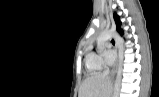 Bronchial mucoepidermoid carcinoma (Radiopaedia 57023-63895 Sagittal 129).jpg