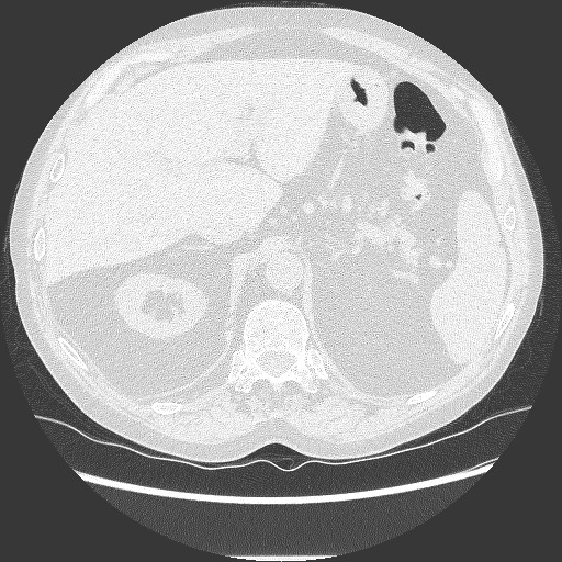 File:Bronchial stenosis - lung transplant (Radiopaedia 73133-83848 B 30).jpg