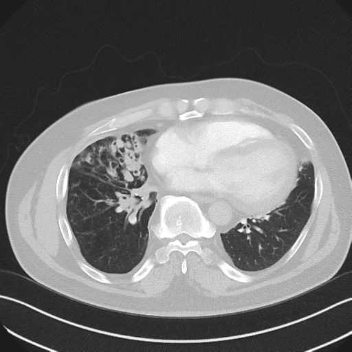 File:Bronchiectasis (Radiopaedia 39385-41666 Axial lung window 42).png