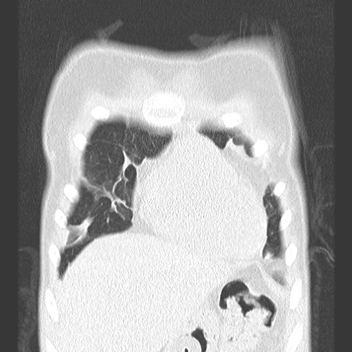 File:Bronchiolotis obliterans (Radiopaedia 73769-84575 Coronal lung window 9).jpg