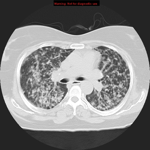 Bronchoalveolar carcinoma (Radiopaedia 13224-13233 Axial lung window 20).jpg