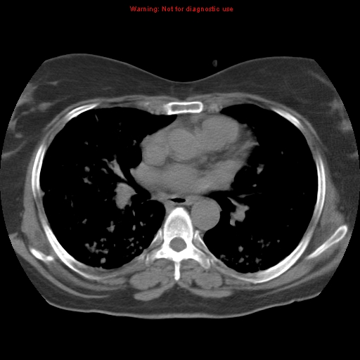 File:Bronchoalveolar carcinoma (Radiopaedia 13224-13233 Axial non-contrast 24).jpg