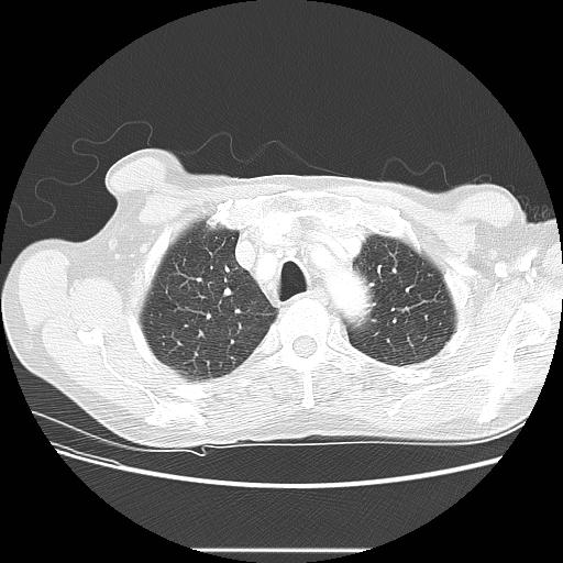 Bronchocele (Radiopaedia 17097-16795 Axial lung window 24).jpg