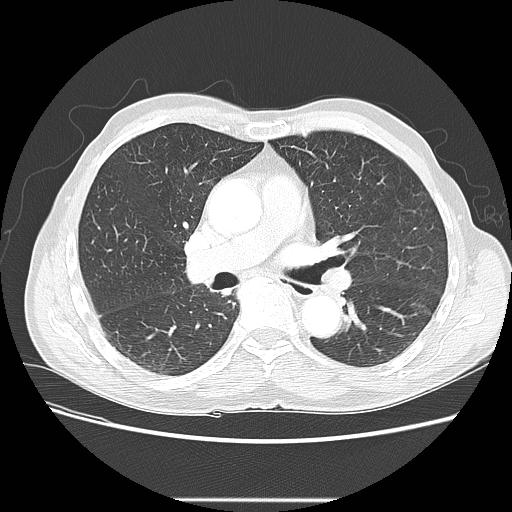 Bronchocele (Radiopaedia 17097-16795 Axial lung window 57).jpg