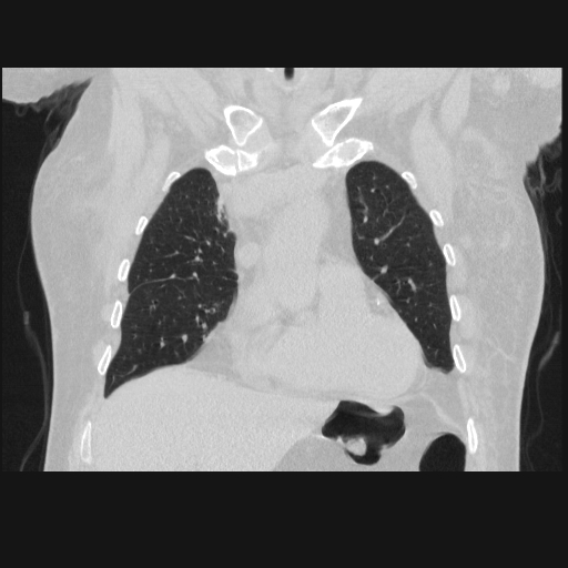 File:Bronchogenic carcinoma with metastatic lymphadenopathy (Radiopaedia 37671-39569 Coronal lung window 14).jpg