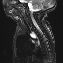 File:Bronchogenic cyst (Radiopaedia 27207-27380 Sagittal STIR 4).jpg