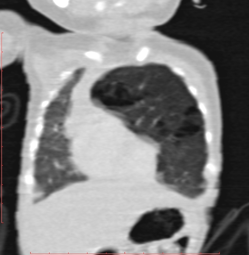 Bronchogenic cyst (Radiopaedia 78599-91409 Coronal lung window 61).jpg