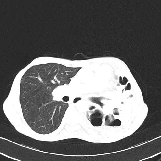 Bronchopleural fistula secondary to tuberculosis (Radiopaedia 20415-20322 Axial lung window 28).jpg
