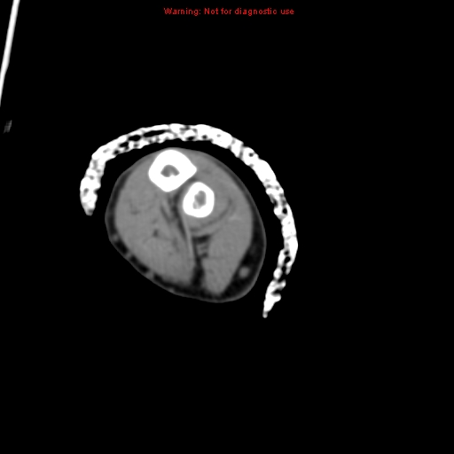 Brown tumor (Radiopaedia 12460-12694 Axial non-contrast 119).jpg