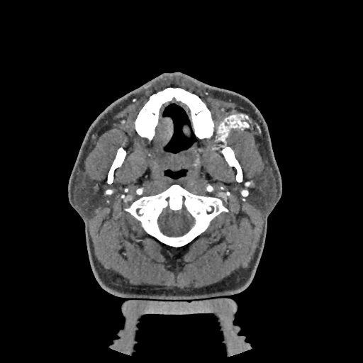 Buccal fat pad arteriovenous malformation (Radiopaedia 70936-81144 D 207).jpg