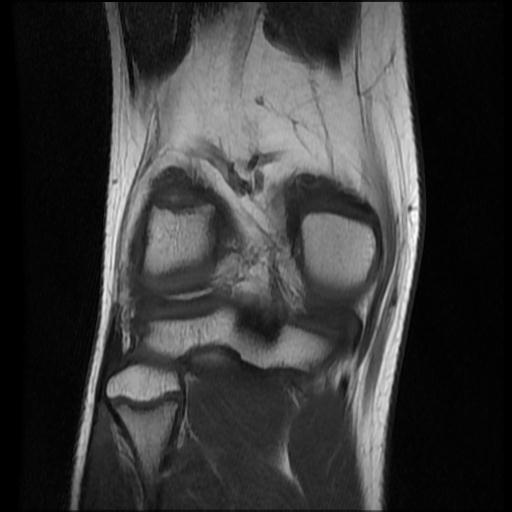 File:Bucket handle tear - lateral meniscus (Radiopaedia 72124-82634 Coronal T1 13).jpg
